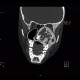 Fibrous dysplasia of the left maxillary sinus: CT - Computed tomography